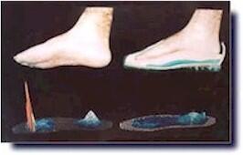 Plantar pressure map with and without an orthodontic image.