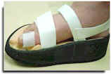 Carville sandal with relief for great toe lesion