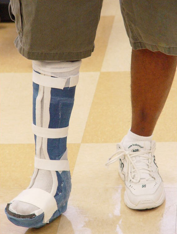 Total Contact Cast (TCC) and the Posterior Walking Splint (PWS) image.